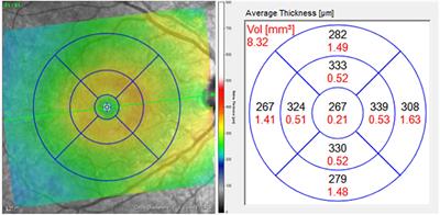 Retinal nerve fiber layer in frontotemporal lobar degeneration and amyotrophic lateral sclerosis